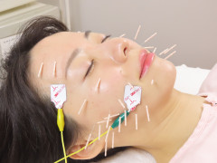 ダイヤモンド美容鍼４５分