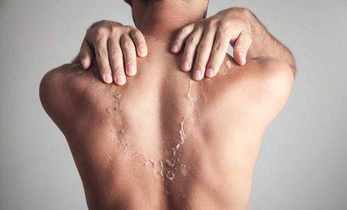 皮がむけた背中