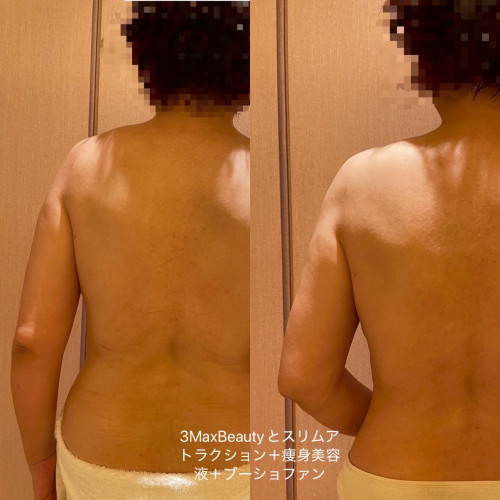 究極の彫刻痩身術