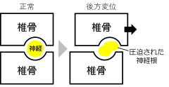 圧迫された神経根.jpg