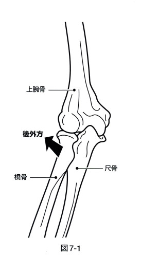 橈骨後方変位.jpg