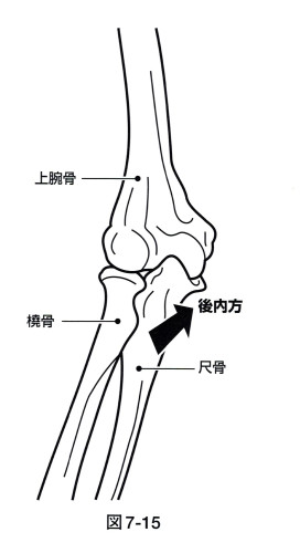 尺骨後方変位.jpg