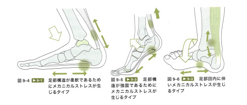 足底筋膜炎3タイプ.jpg