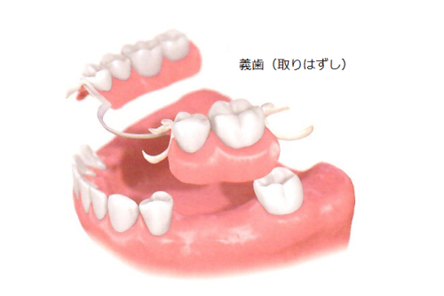 義歯の図.png