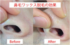 男の脱毛
