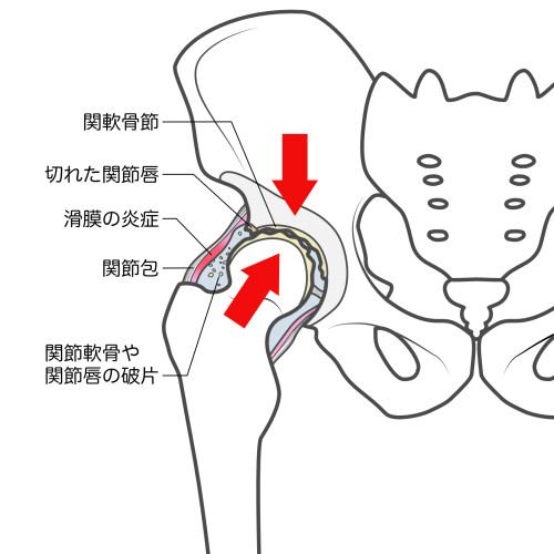 股関節の痛み.jpg