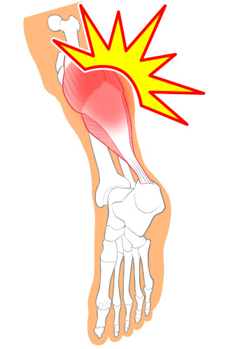 下腿三頭筋のけが.jpg