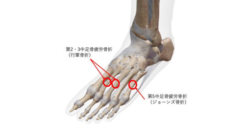 中足骨疲労骨折.jpg