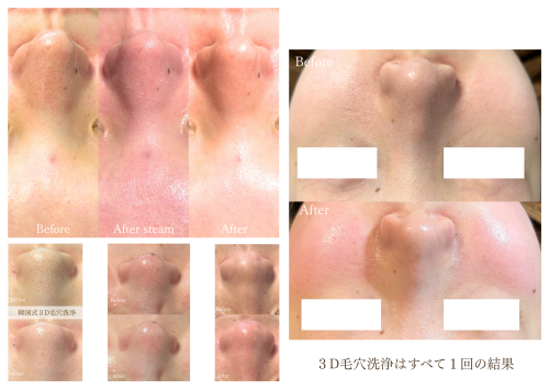 毛穴洗浄BA.png