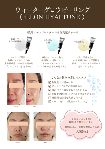 ハイアルチューン.png
