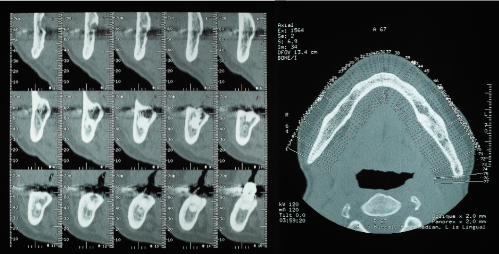 歯科用CTによる診査 (2).png