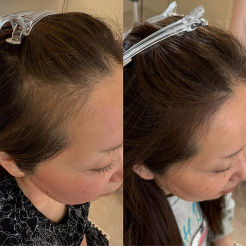 生え際から広がる薄毛悩み