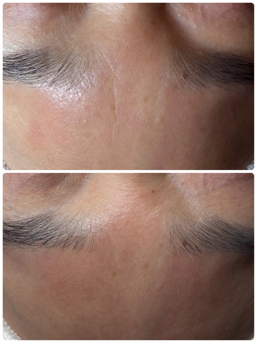 プロセルフェイシャル２回