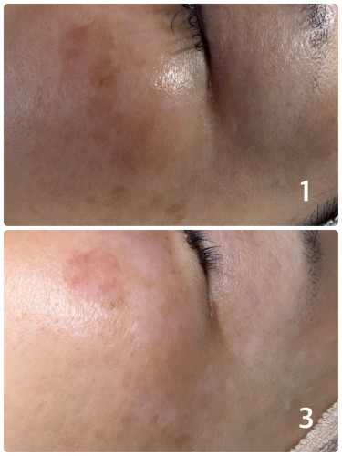 プロセルフェイシャル２回