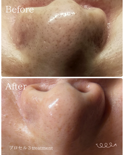プロセルフェイシャル３回