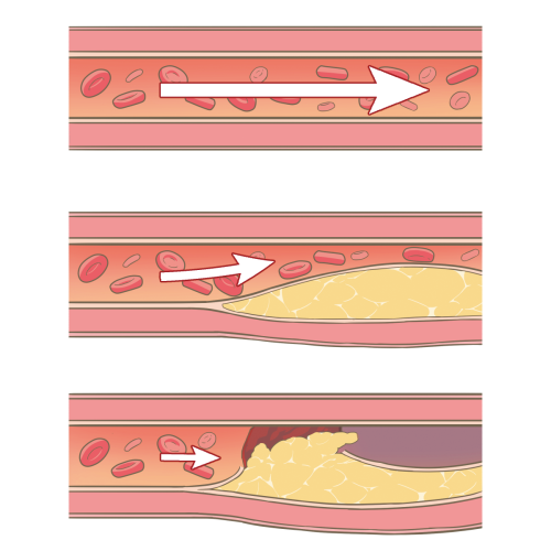 clogged-blood-vessels.png
