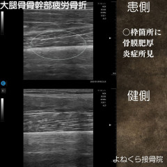 大腿骨疲労骨折.jpg