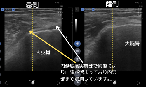 内側広筋損傷エコー像.png