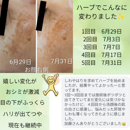 お顔そりとハーブピーリングお客様ご感想