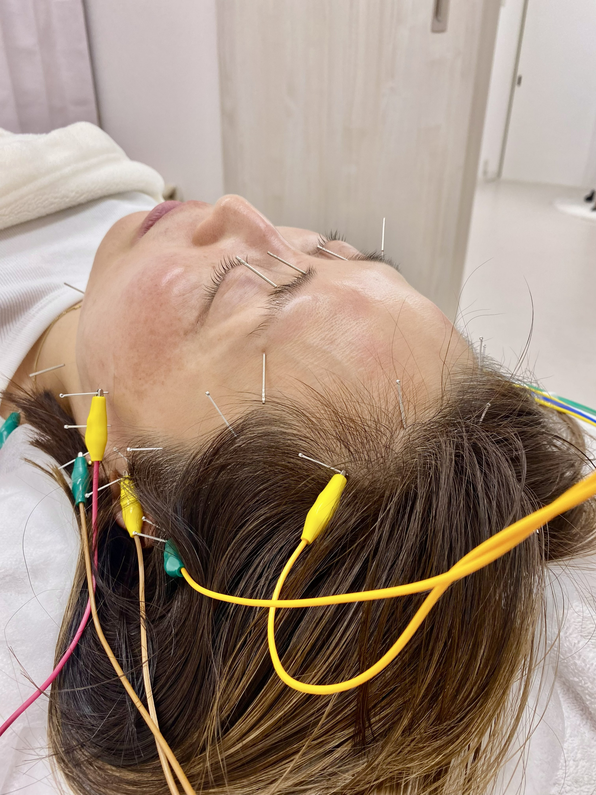 ”内側”からエイジングケア　大人の美容鍼