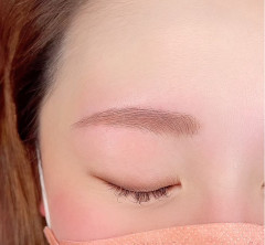 Brow lift