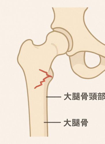 大腿骨頸部骨折1.png
