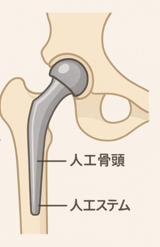 大腿骨頸部骨折2.png