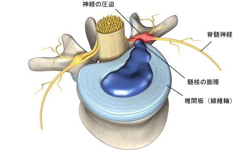 頚椎ヘルニア.png