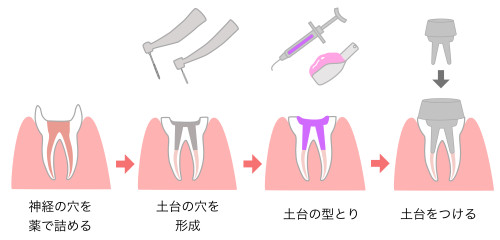 ファイバーポスト
