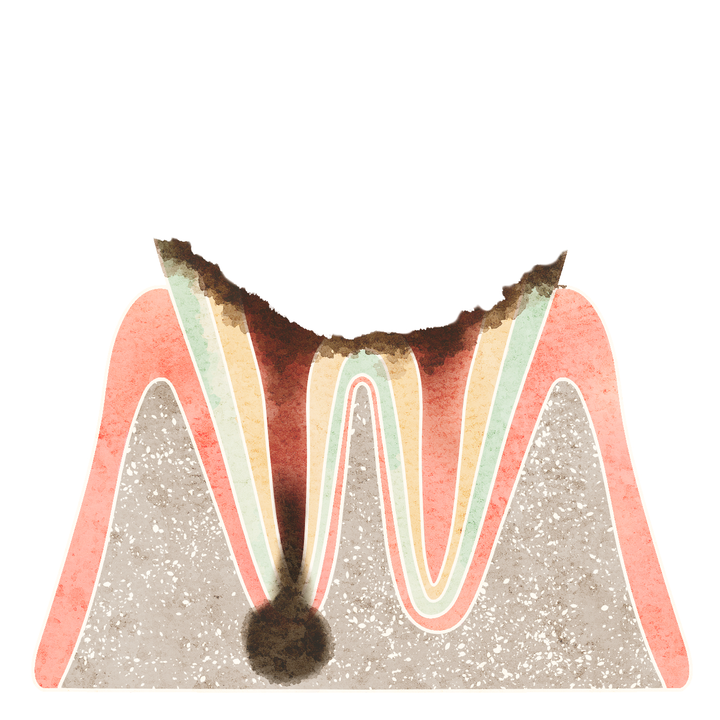 歯の根のばい菌感染について