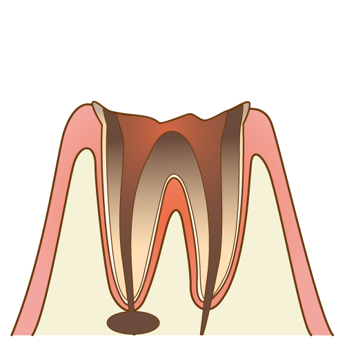 大きい虫歯の治療方法（矯正的挺出術、外科的挺出術）
