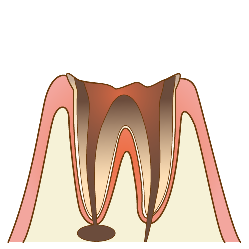 大きい虫歯の治療方法（矯正的挺出術、外科的挺出術）