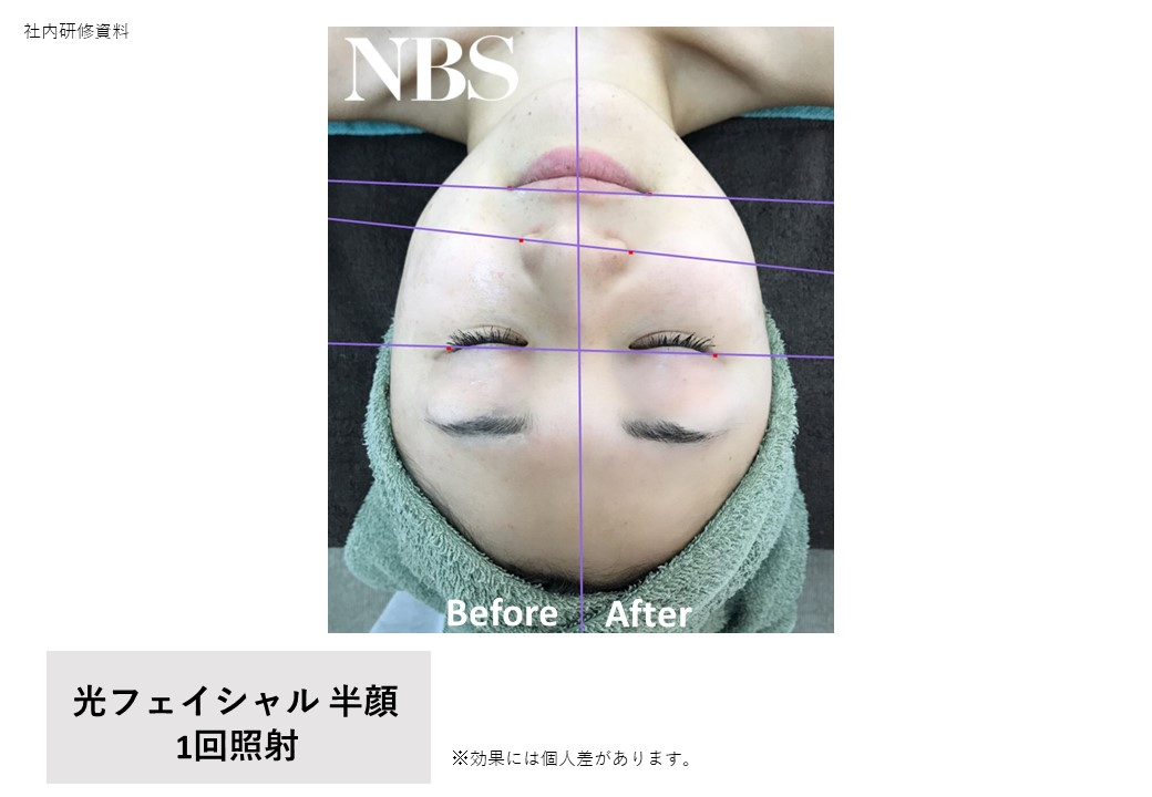 光フェイシャル.png