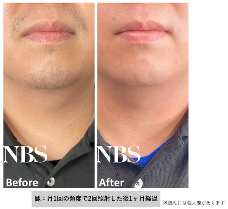 男性ひげ脱毛２.png