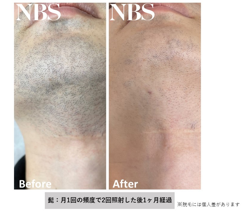 男性脱毛前後.png