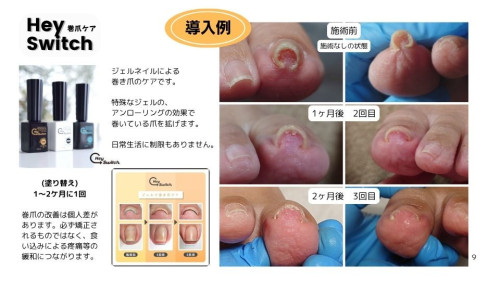 巻き爪メニュー