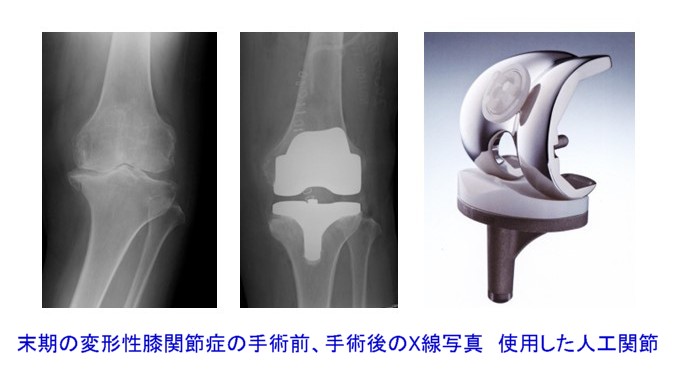 膝関節の手術 - 健康/医学