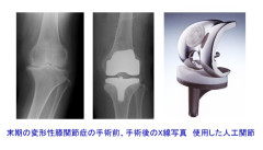 変形性膝関節症の治療　　手術療法