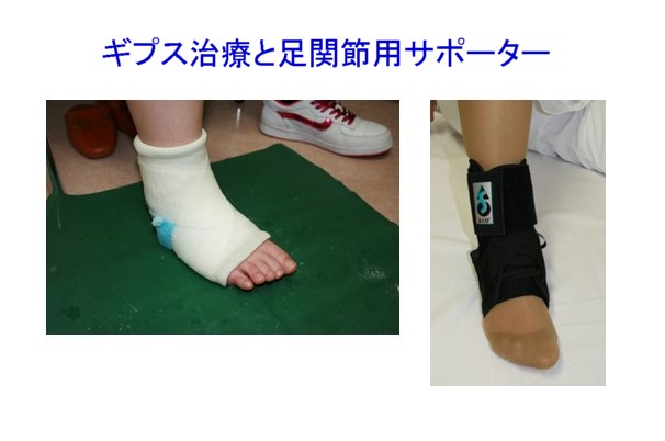 足の捻挫とその後遺症について 早期の適切な治療が重要 - 札幌膝関節