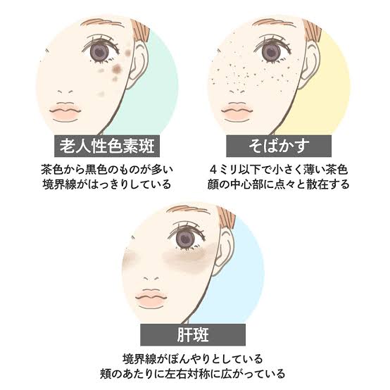 女性ホルモンと肝斑。