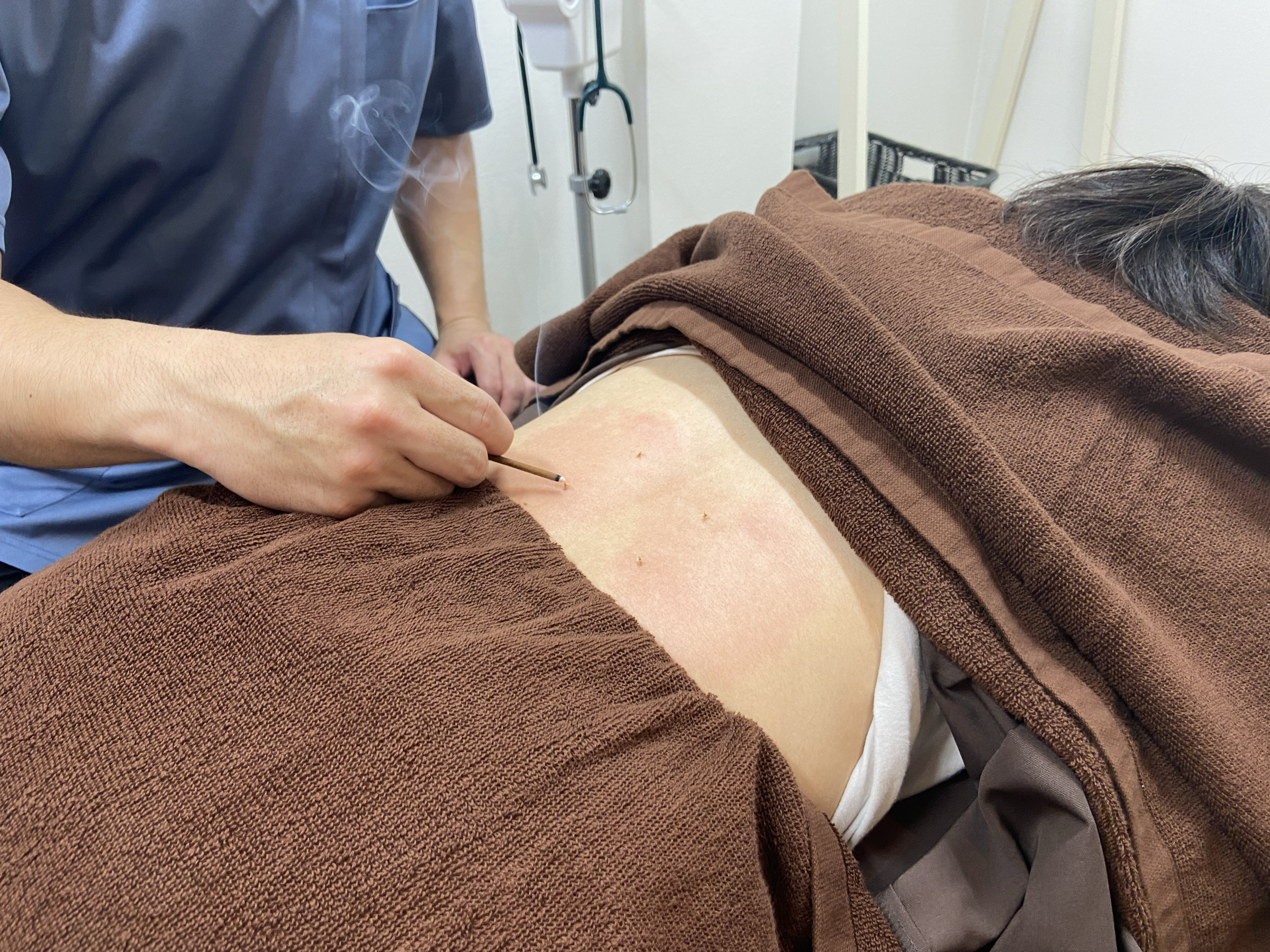 灸(きゅう)施術
