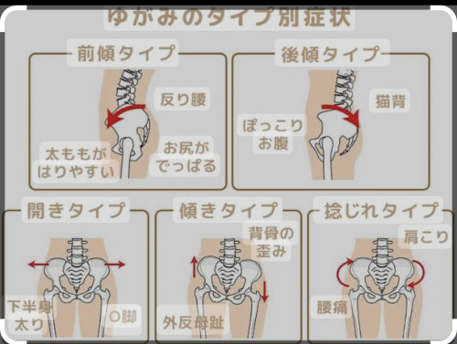 骨盤矯正
