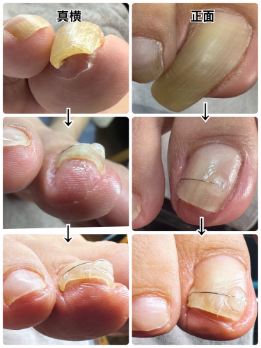 お自身で切れない肥厚爪