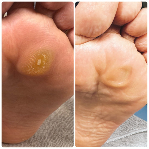 ウオノメバイバイ。