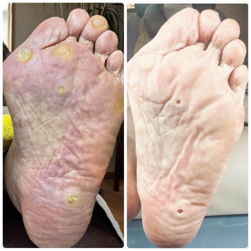 大きいウオノメ