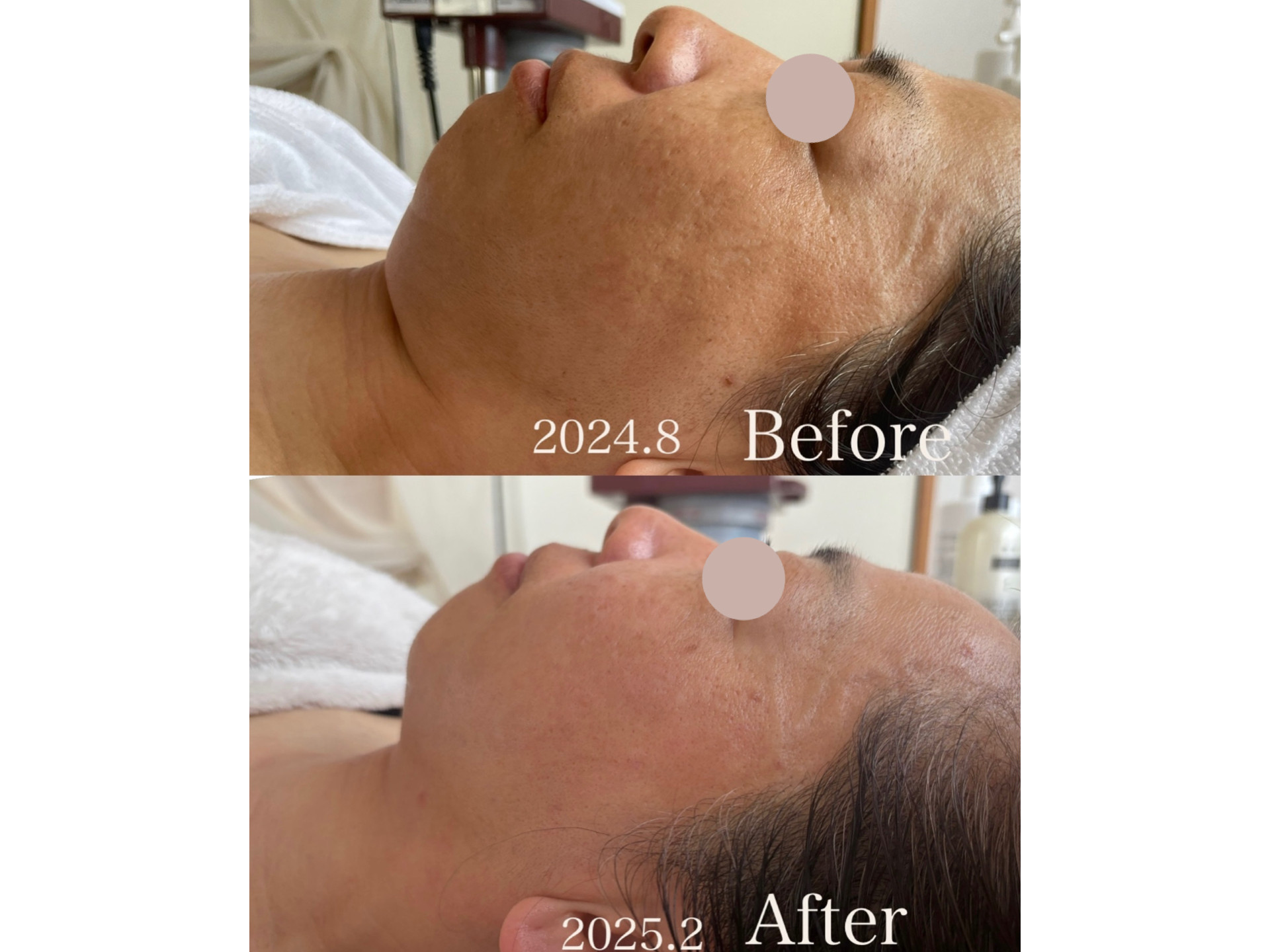 幹細胞フェイシャル