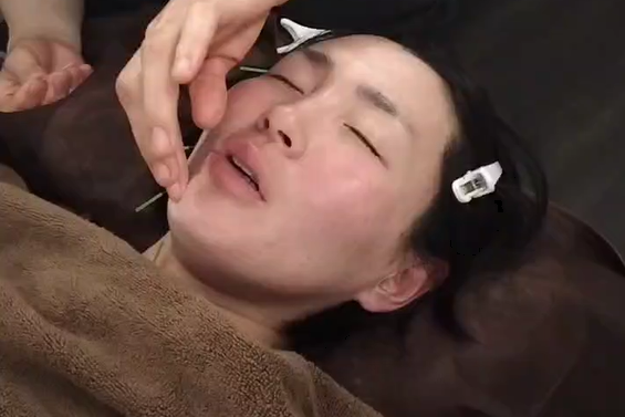 美容鍼