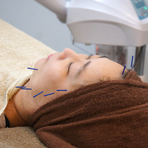 堺市東区のクシロ鍼灸整骨院での美容鍼施術風景をご紹介