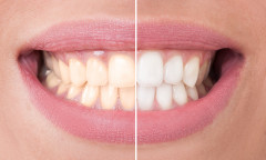 TeethWhitening-2.jpg
