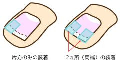 陥入爪装着図
